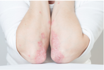 Psoríase é uma doença cutânea que pode ocorrer nos pacientes com espondilite anquilosante.