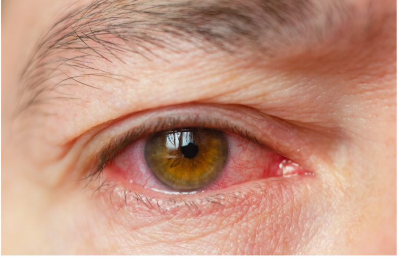 A uveíte pode ocorrer em 25% dos pacientes com espondilite anquilosante.