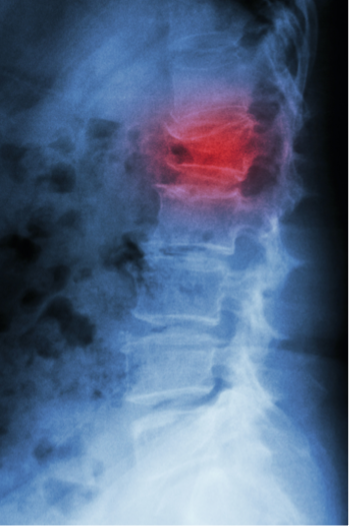 Fraturas vertebrais podem levar a dor intensa.
