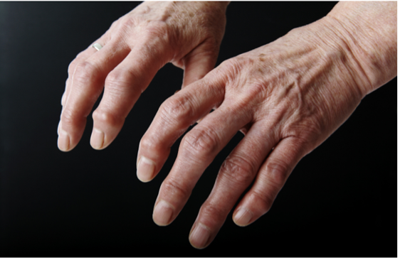 Nódulos nas mãos de pessoa com artrose.