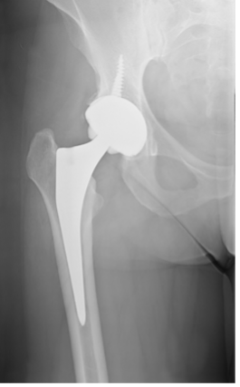 Prótese de fêmur em paciente com artrose