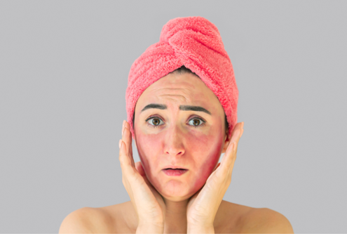 Rash malar é uma mancha vermelha no rosto, acometendo as bochechas, e ocorre após exposição solar.