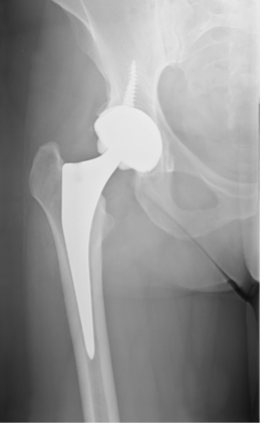 Prótese de fêmur em paciente com artrose