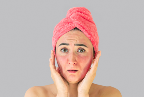 Rash malar é uma mancha vermelha no rosto, acometendo as bochechas, e ocorre após exposição solar.